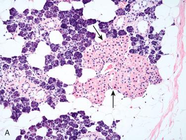 Fig. 19-7, Oncocytic metaplasia.