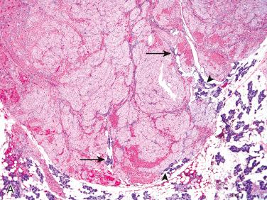 Fig. 19-8, Oncocytosis.