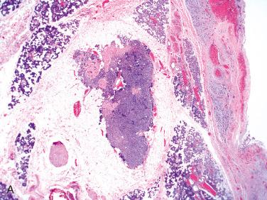 Fig. 19-9, Intercalated duct hyperplasia.