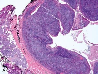 Fig. 19-10, Parotid gland lymphoepithelial cyst.