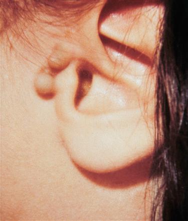 Fig. 23-1, Accessory tragus.