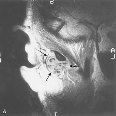 Fig. 23-13, Synovial chondromatosis with synovial bodies.