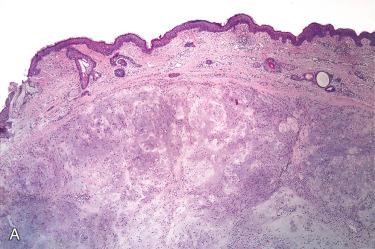 Fig. 23-14, Synovial chondromatosis.