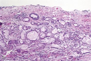 Fig. 23-3, Middle ear heterotopia.