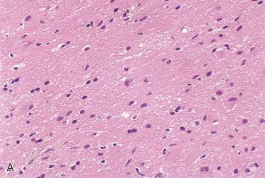 Fig. 23-4, Acquired encephalocele.