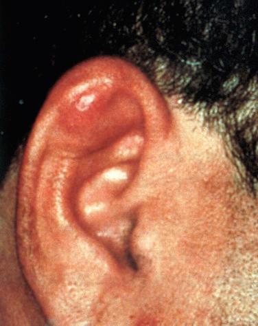 Fig. 23-7, Idiopathic cystic chondromalacia.