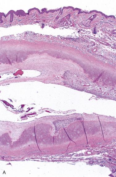 Fig. 23-8, Idiopathic cystic chondromalacia.