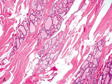 Fig. 27-1, Thyroid tissue in skeletal muscle.