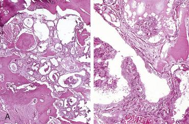 Fig. 27-11, Papillary thyroid carcinoma in thyroglossal duct cyst.