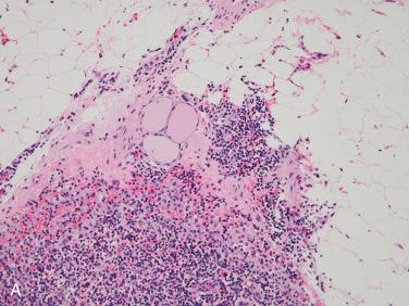 Fig. 27-12, Benign nodal thyroid inclusions.