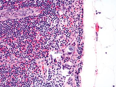 Fig. 27-13, Metastatic papillary thyroid carcinoma.