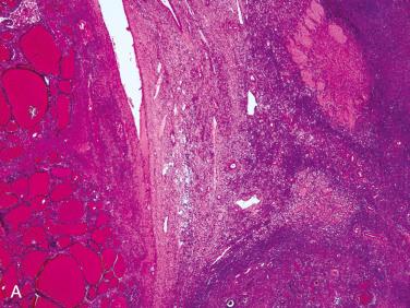 Fig. 27-16, Malignant struma.