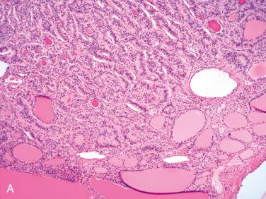 Fig. 27-17, Strumal carcinoid.