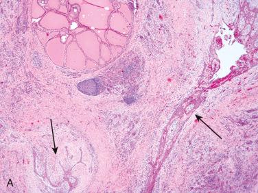 Fig. 27-18, Squamous metaplasia in the thyroid gland.