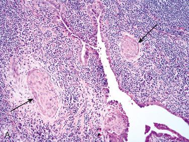 Fig. 27-19, Squamous metaplasia occurring in association with papillary thyroid carcinoma.