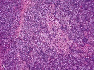 Fig. 27-20, Oncocytic (oxyphilic) metaplasia.