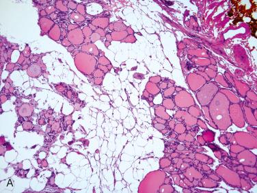 Fig. 27-2, Thyroid tissue in fat.