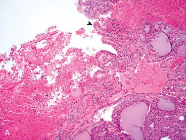 Fig. 27-21, Cellular adenomatoid nodule with oncocytic (oxyphilic) metaplasia.