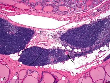 Fig. 27-22, Intrathyroidal thymic tissue.