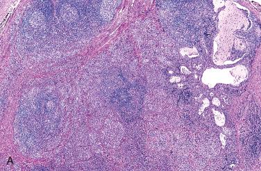 Fig. 27-23, Intrathyroidal branchial cleft-like (epithelial or lymphoepithelial) cysts.