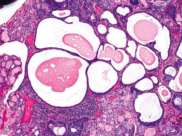 Fig. 27-24, Intrathyroidal branchial cleft-like (epithelial or lymphoepithelial) cysts.