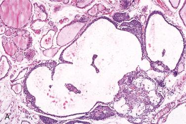 Fig. 27-26, Cystic solid cell nests in the normal thyroid gland.