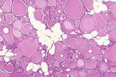 Fig. 27-27, Fat in the thyroid gland.