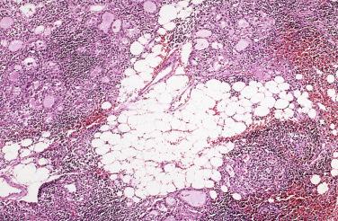 Fig. 27-28, Fat in Hashimoto thyroiditis.