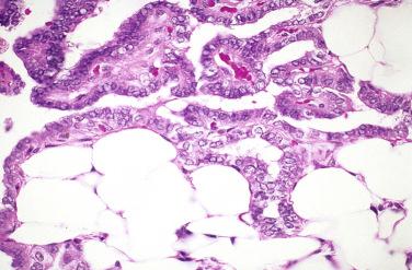 Fig. 27-29, Fat in papillary thyroid carcinoma.