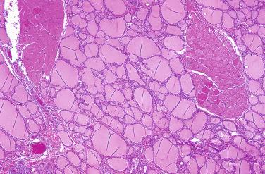 Fig. 27-30, Mature skeletal muscle in the thyroid gland.