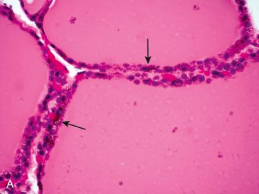 Fig. 27-32, Minocycline pigment (black thyroid).