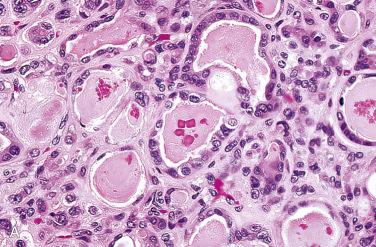 Fig. 27-33, Crystals in the thyroid gland.