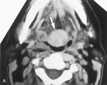 Fig. 27-4, A, Contrast-enhanced axial CT scan reveals a well-delineated, enhancing midline lesion at the tongue base (arrow) . B, Midsagittal T1-weighted MR image demonstrates a sharply defined tongue base mass (dot) with signal intensity isointense to tongue musculature. C, Axial CT scan with contrast enhancement at the level of the lower neck reveals a complete absence of normal thyroid tissue in its expected location. V, Large left internal jugular vein; black dots, anterior jugular veins; S, sternocleidomastoid muscles.