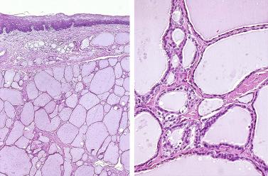 Fig. 27-5, Lingual thyroid.