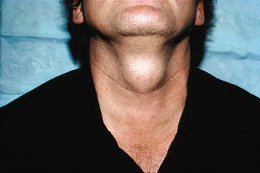 Fig. 27-6, Thyroglossal duct cyst.