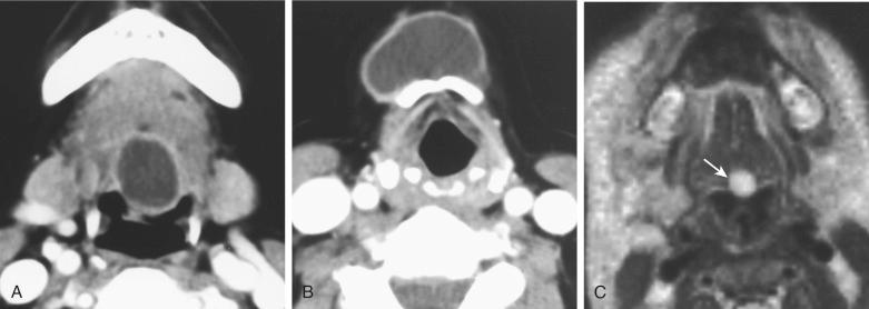 Fig. 27-7, Thyroglossal duct cyst.