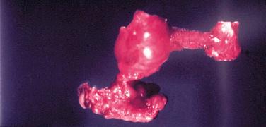 Fig. 27-8, Thyroglossal duct cyst.