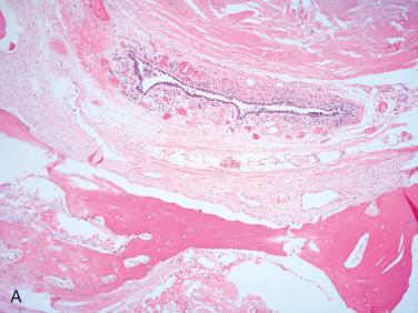 Fig. 27-9, Thyroglossal duct cyst.