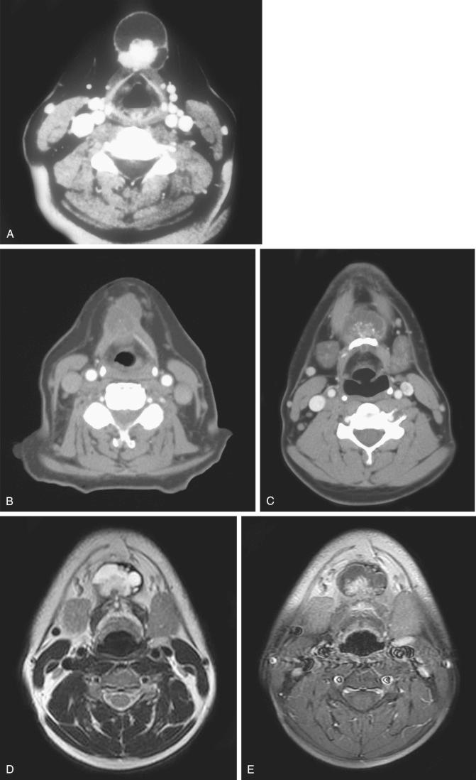 Fig. 27-10, Papillary thyroid carcinoma in thyroglossal duct cyst.