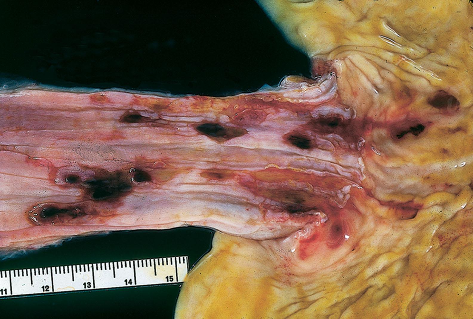 Figure 1.1, Esophagitis. Severe, with hemorrhagic erosions.