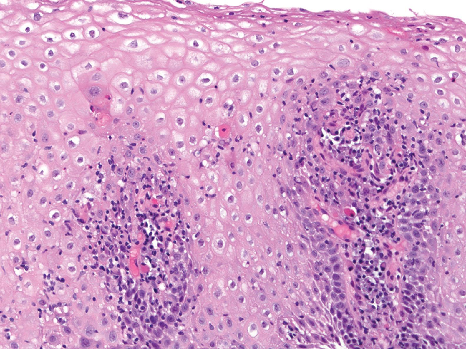 Figure 1.11, Crohn’s disease. Inflammation is predominantly lymphocytic with a few eosinophils and dyskeratotic keratinocytes.