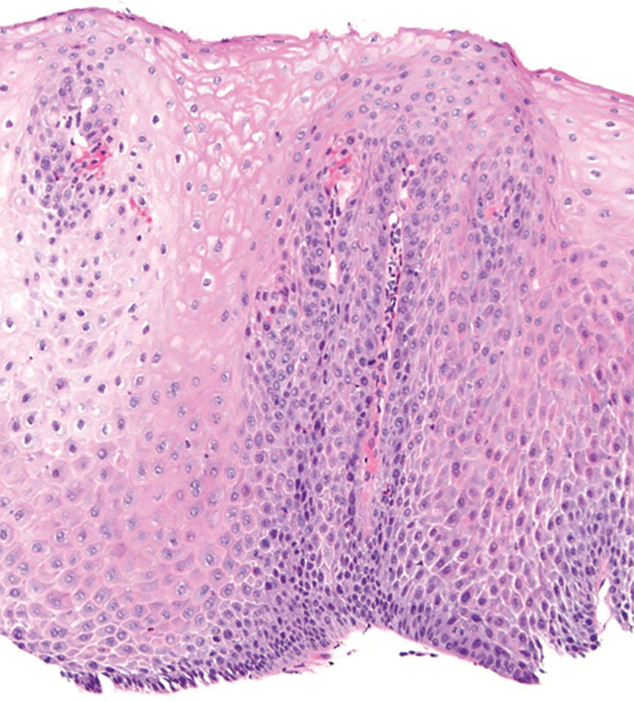 Figure 1.2, Reflux esophagitis. Basal cell hyperplasia, elongation of papillae, and spongiosis.