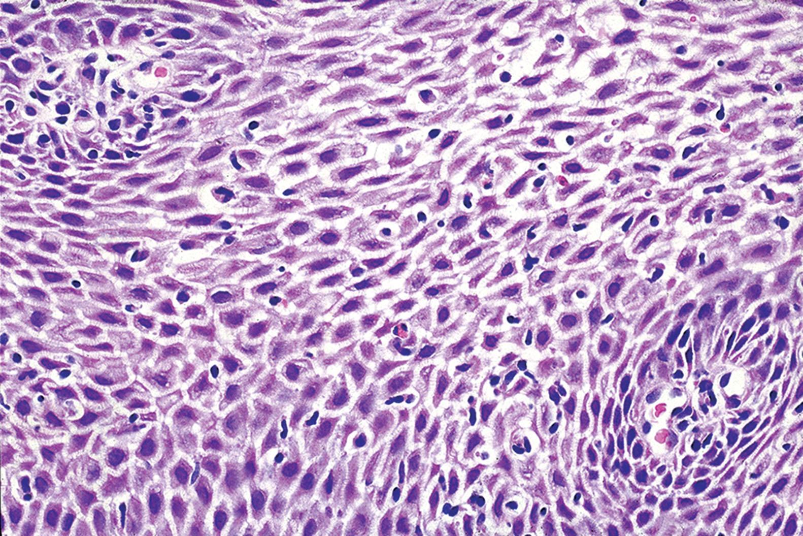 Figure 1.3, Reflux esophagitis. Increased numbers of intraepithelial lymphocytes are present among dilated intercellular spaces (spongiosis).