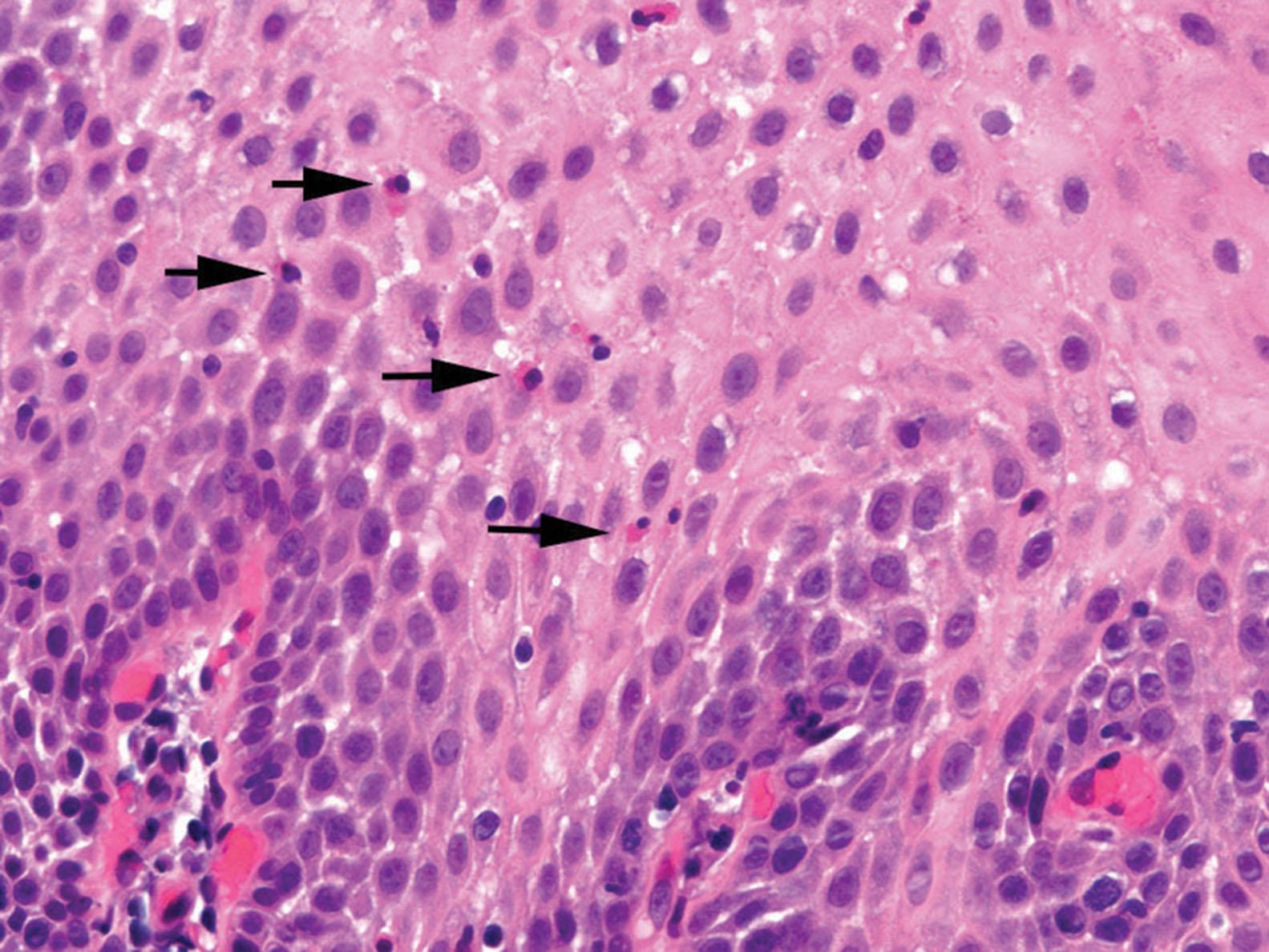 Figure 1.4, Reflux esophagitis. Intraepithelial eosinophils (arrows) .