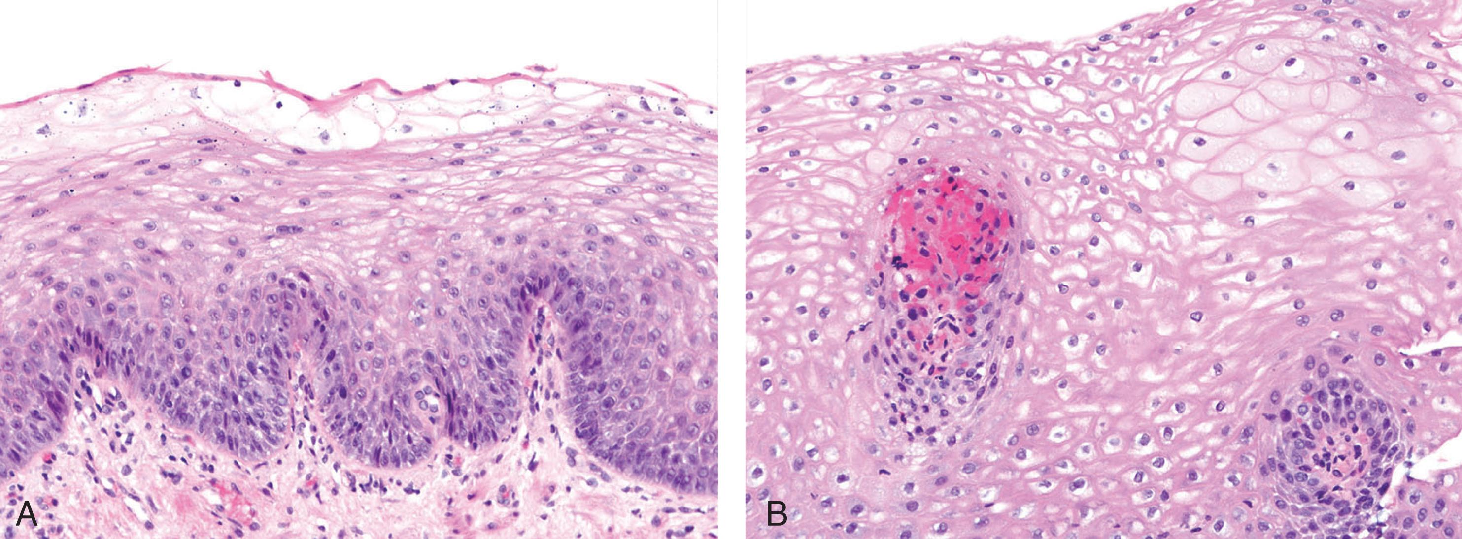 Figure 1.5, Reflux esophagitis. Balloon cells can be present along the luminal aspect ( A ) or within ( B ) the squamous epithelium.