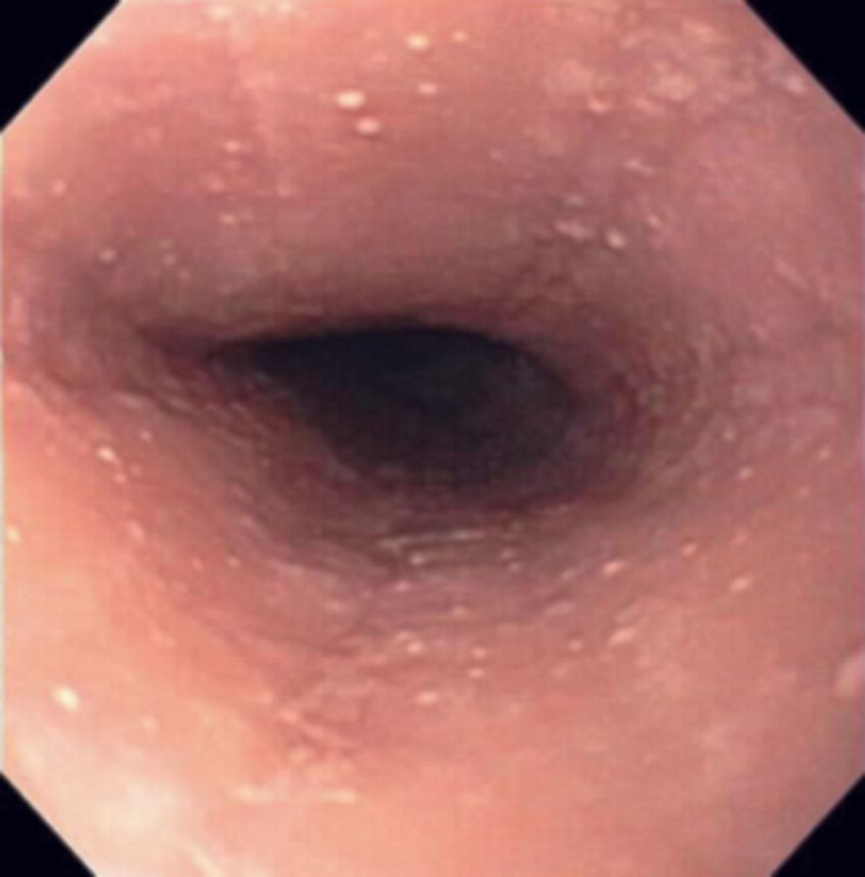 Figure 1.6, Eosinophilic esophagitis—endoscopy. Mucosal granularity.