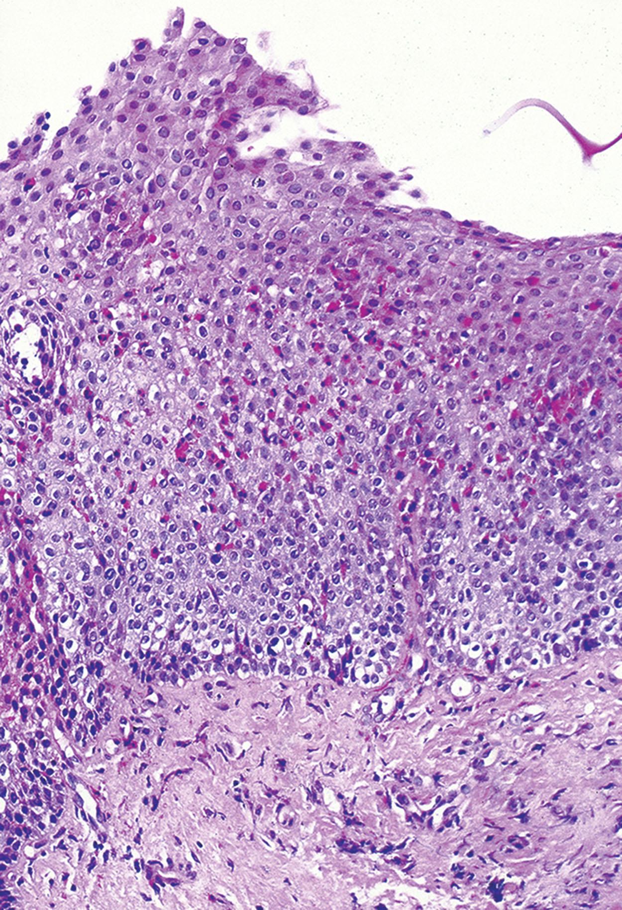 Figure 1.8, Eosinophilic esophagitis. Intense eosinophilic infiltrate.