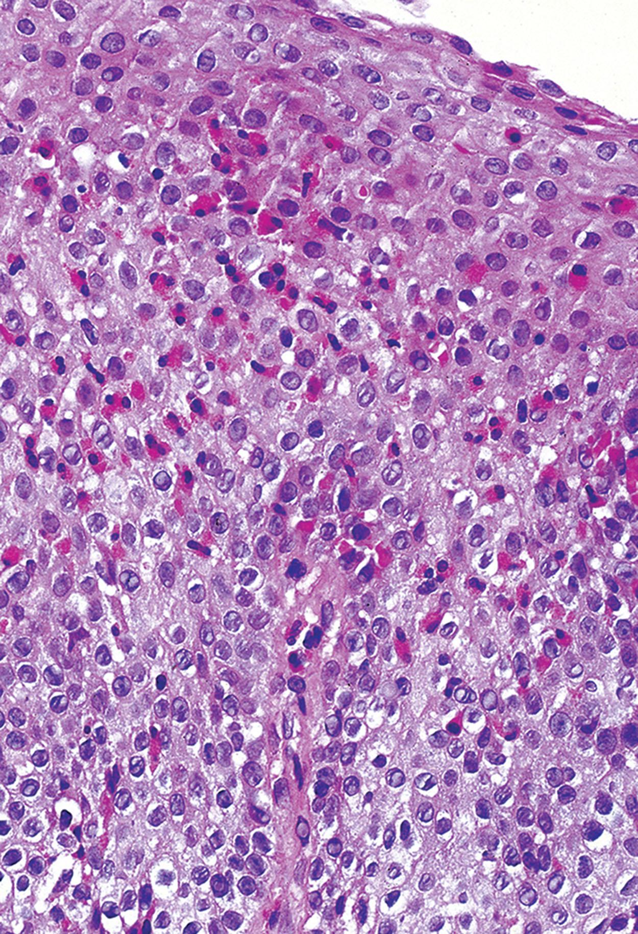 Figure 1.9, Eosinophilic esophagitis. Intraepithelial eosinophils (>20/hpf).