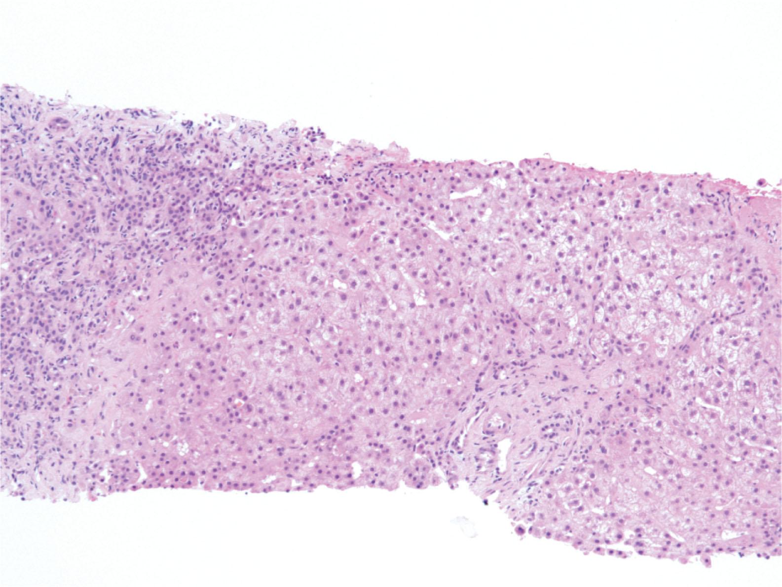 Figure 17.13, Diffuse swelling of hepatocytes with pale appearance and bile ductular proliferation, characteristic of early stages of fibrosing cholestatic hepatitis C.