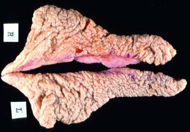 Fig. 1.1, Condylomata acuminata. The vulva is involved by confluent condylomas.